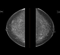 现场妇女健康，白兔和圣路易斯华盛顿大学联合探索乳房密度和乳腺癌风险的影响