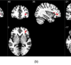 图1所示。组分析susceptibility-weighted成像表现出更高的susceptibility-weighted成像值COVID组与健康对照组相比。三个重要的集群主要被发现在前额叶皮层的白质区域和脑干。集群(a)和(b)是观察附近的脑白质双边眶额回,而(c)位于中脑区域。