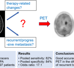 一个新的或增加对比度增强T1 MRI代表治疗或进步的结果/复发性肿瘤吗?这种常见的临床难题可以通过氨基酸来解决宠物具有良好的诊断准确性。”typeof=