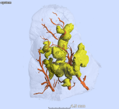 姜状坏死病灶的三维分割(黄色)和周围血管(红色)的样本内分枝杆菌tuberculosis-infected人类肺组织(透明的表面)。非洲卫生研究所