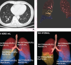 76岁男性患者，因肺癌行右下肺叶切除术。(A)术前DECT胸透轴向图像显示右下叶2.3 cm部分实性结节(箭头)。根据手术标本的病理评估，结节证实为肺腺癌。(B) 70 kev彩色叠加单色图像显示5个肺叶分割。红色表示上叶;黄色表示右中叶;蓝色表示下叶。来自(C)的三维体绘制图像