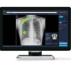 该软件将被嵌入爱克发的MUSICA工作站，该工作站为放射医师提供了直观的界面，并被放射医师社区公认为具有出色的图像质量。