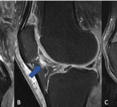 图1。膝关节炎症时，膝关节附近的脂肪垫(Hoffa’s脂肪垫，髌下脂肪垫)在MRI上会发生信号改变。(A)膝关节正常，无炎症征象。(B)箭头指向脂肪垫区域(通常为黑色)中信号较高的限定区域(亮线)，这表明开始有炎症反应。(C)整个脂肪垫信号较高(浅灰色带白线)，是膝关节进行性炎症的征象。