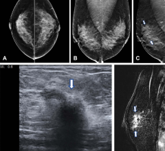 在超过一百万名妇女的一项研究中,数字乳房tomosynthesis(印度生物技术部)显示改善乳腺癌筛查结果在筛选标准的数字乳房x光检查。这项研究的结果发表在放射学,日记的北美放射学会(RSNA)
