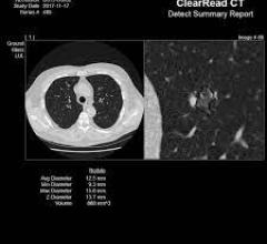 ClearRead CT以CVI改善胸部结节检测