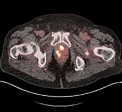 18 f - rhpsma 7.3宠物图像显示多个领域的吸收对刚被诊断为前列腺癌的前列腺的男人照片的蓝色地球诊断