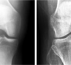AI试图检测是否有飙升在膝关节胫骨结节。胫骨飙升可能是骨关节炎的迹象。图片:Jyvaskyla大学。图片由Jyvaskyla大学的