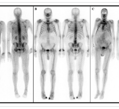 该图突出显示了3例最终诊断为低摄取级别(Perugini分级1)的患者。图B所示的患者的心内膜心肌活检结果显示atr - ca为潜在病理。