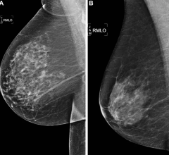 在一个大型的研究成千上万的乳房x光检查,人工智能(AI)算法优于标准的临床风险模型预测的五年患乳腺癌的风险。这项研究的结果发表在放射学,日记的北美放射学会(RSNA)。