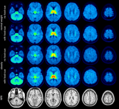 分子成像和18 f-flubatine PET / MRI显示神经受体引起的大脑中肥胖的人对食物的反应不同线索比正常体重的个体,使神经受体引起肥胖治疗方法和治疗的首要目标