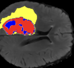 AI-annotated医学图像显示增强的肿瘤,肿瘤区域核心和水肿。莫纳什大学提供的图片