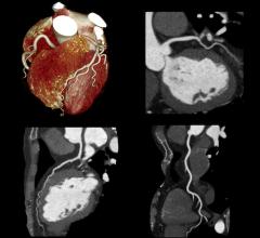 心脏冠状动脉计算机断层造影(CCTA)检查显示心肌和冠状动脉的不同视图。这是在佳能Aquilion Prime CT扫描仪上扫描的。