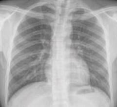 图1所示。正常的胸部x光片