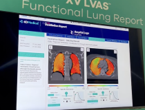 4D Medical在RSNA 2022期间展示的XV LVAS数字通气报告包括放射科医生可以用来为他们的推荐临床医生提供可操作的见解的数据。数据包括通风缺陷百分比(VDP)、潮气量和通风异质性。根据LVAS数学分析，彩色编码的肺部图像显示高通气区域(红色)、正常通气区域(绿色)和过度通气区域(蓝色)。